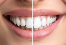 Photo of Преимущества поставить виниры для вашей улыбки