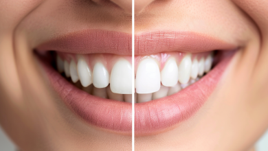 Photo of Преимущества поставить виниры для вашей улыбки